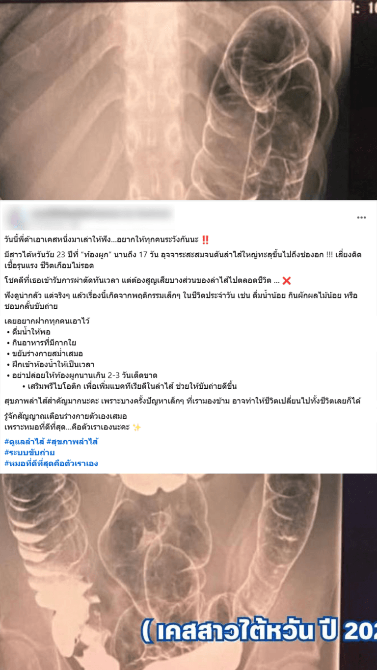 ตรวจสอบแล้ว: ข่าวอ้างท้องผูกนานจนอุจจาระดันทะลุหัวใจ แพทย์ยืนยันเกิดขึ้นไม่ได้จริง