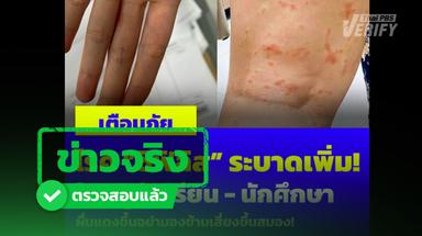 เชื้อซิฟิลิสสามารถติดเชื้อขึ้นสมองได้จริง แพทย์ชี้หากมีความเสี่ยงให้รีบรักษา